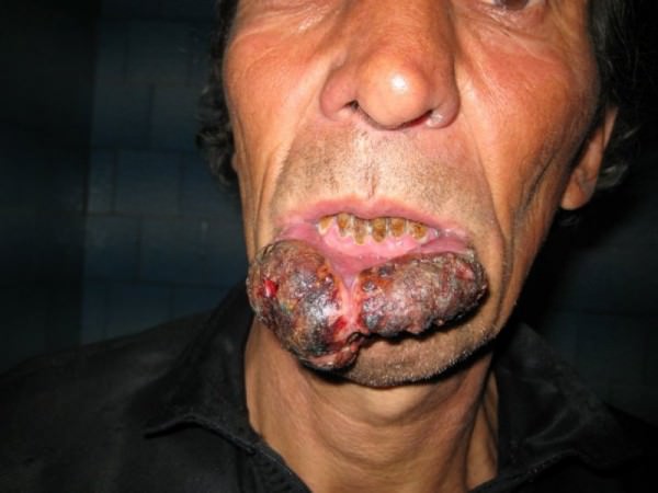 Рак губы от курения