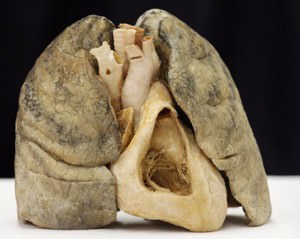 Эмфизема лёгких