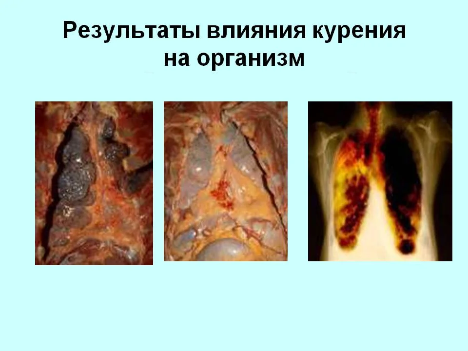 0008-008-Rezultaty-vlijanija-kurenija-na-organizm.webp