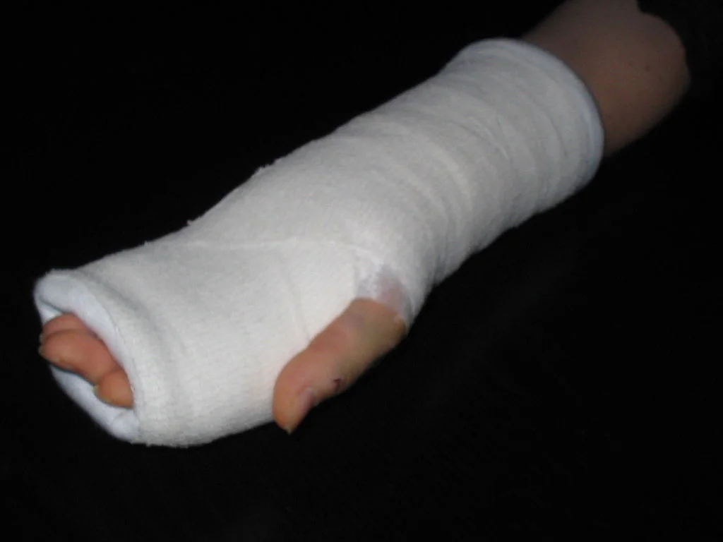1024px-Hand_in_gips.webp