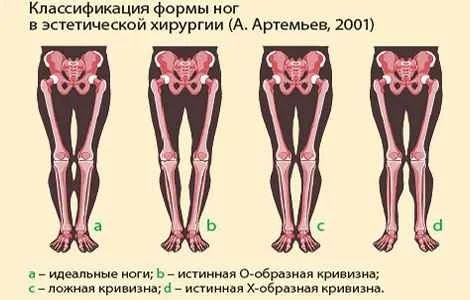 chto-delat-esli-nogi-krivye.webp