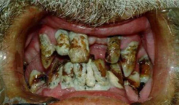 gnilyie-zubyi-u-vzroslogo-cheloveka.webp