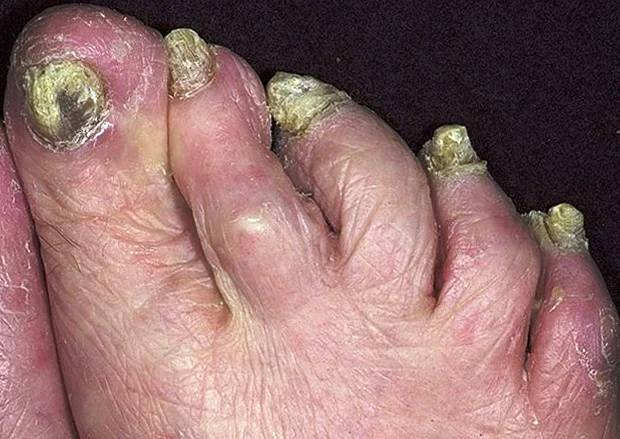 грибок-ногтей-на-ноге.webp