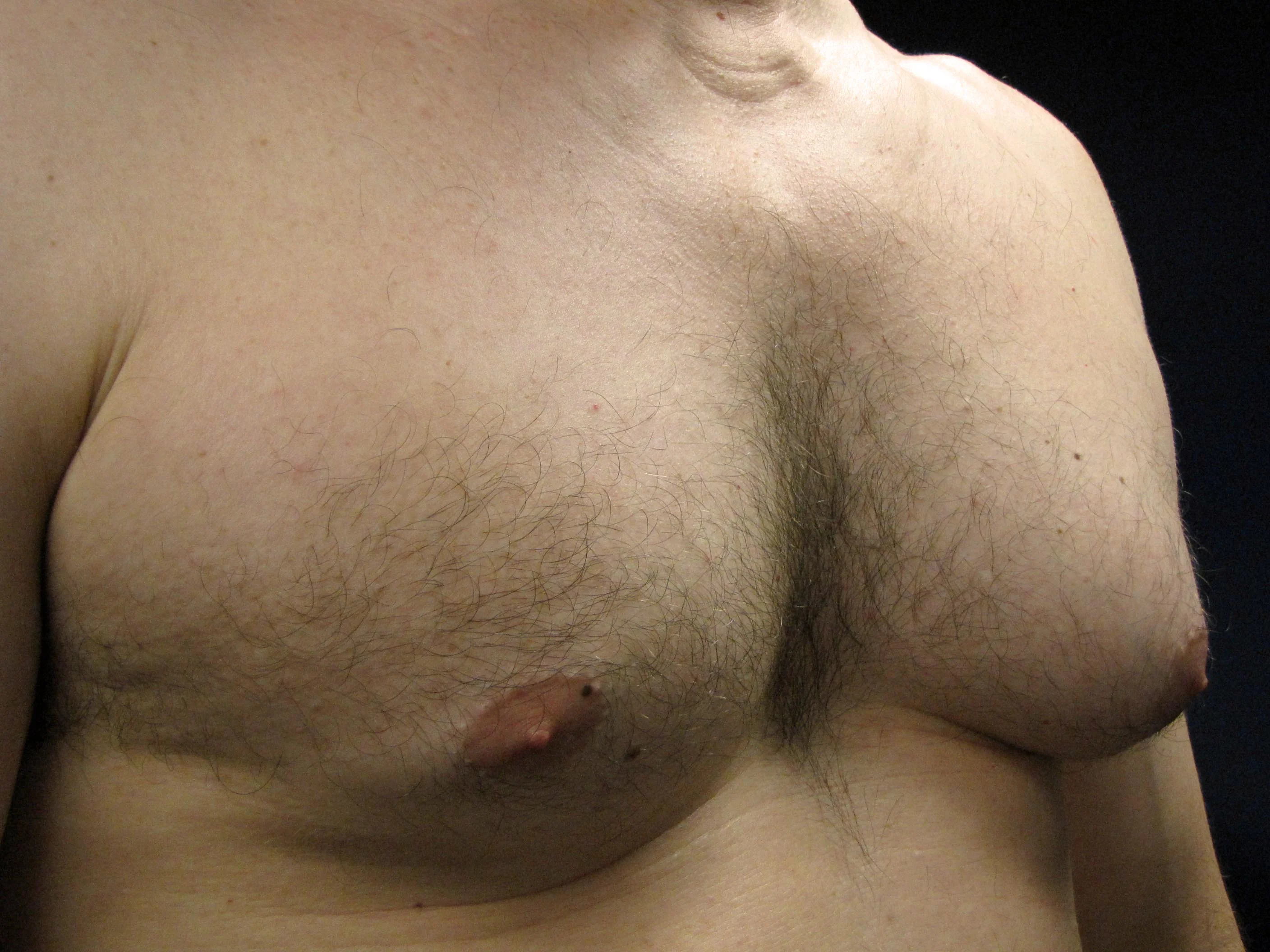 Gynecomastia-11-LO-pre.webp