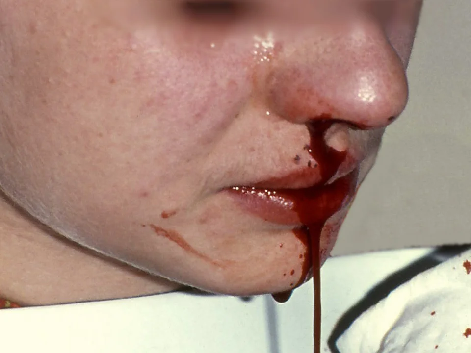 Nose-Bleeding-Or-Epistaxis.webp