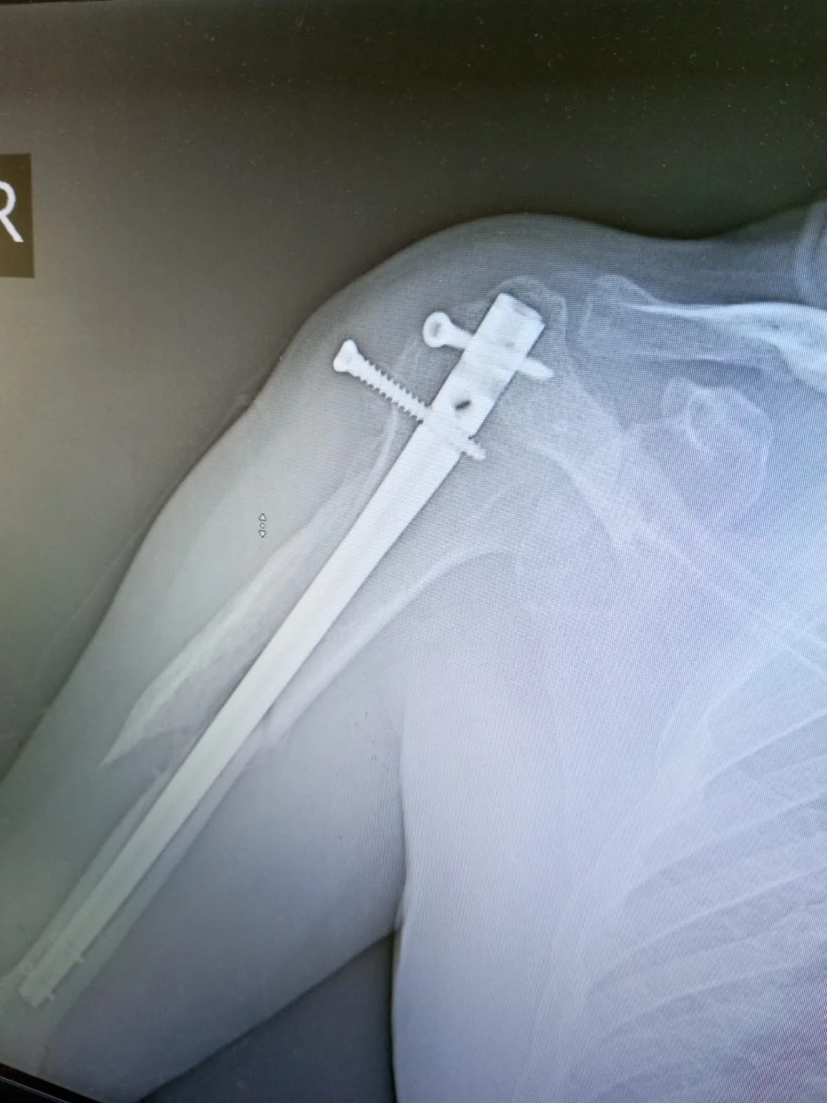 плечо 16.04.webp