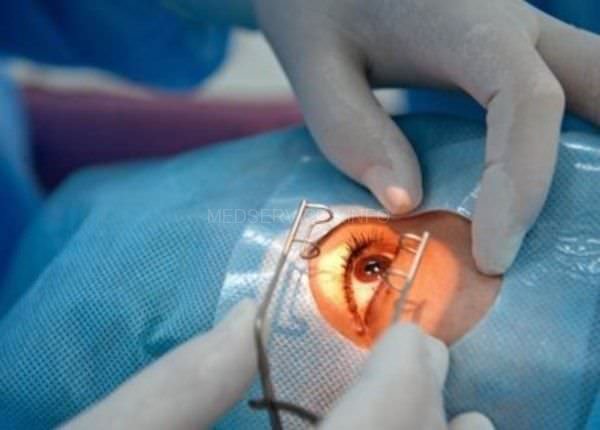 surgery-on-the-eyes-7f-600x430.jpg