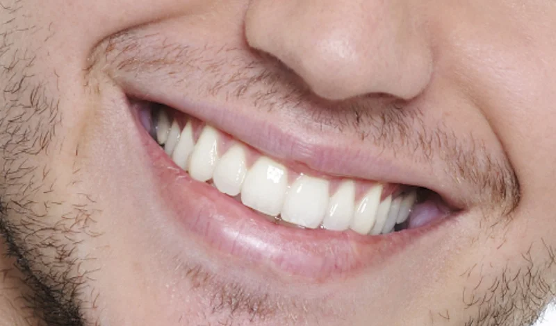 teeth-smile-man.webp