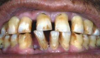 зубы курильщика.webp