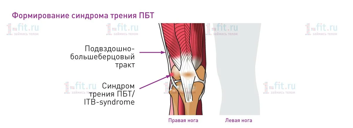 Синдром подвздошно большеберцового тракта. Илиотибиальный синдром. Что такое синдром итибиального тракта. Синдром бегуна колено илиотибиального тракта. Синдром подвздошно большеберцового тракта.