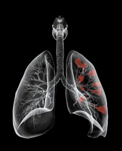 Ученые установили механизм, вызывающий рак легких при курении