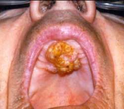 Эпителиальные опухоли полости рта