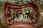 Кошмарные зубы курильщика