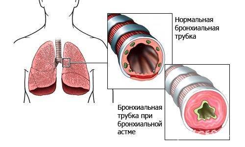 Курение и бронхиальная астма