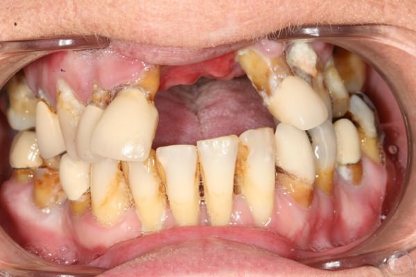 Как отбелить зубы после курения