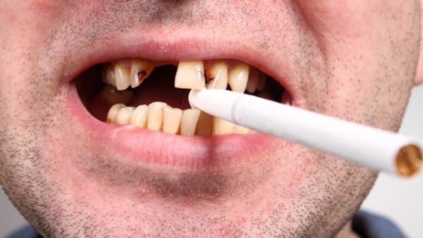 Взаимосвязь курения и стоматологических заболеваний